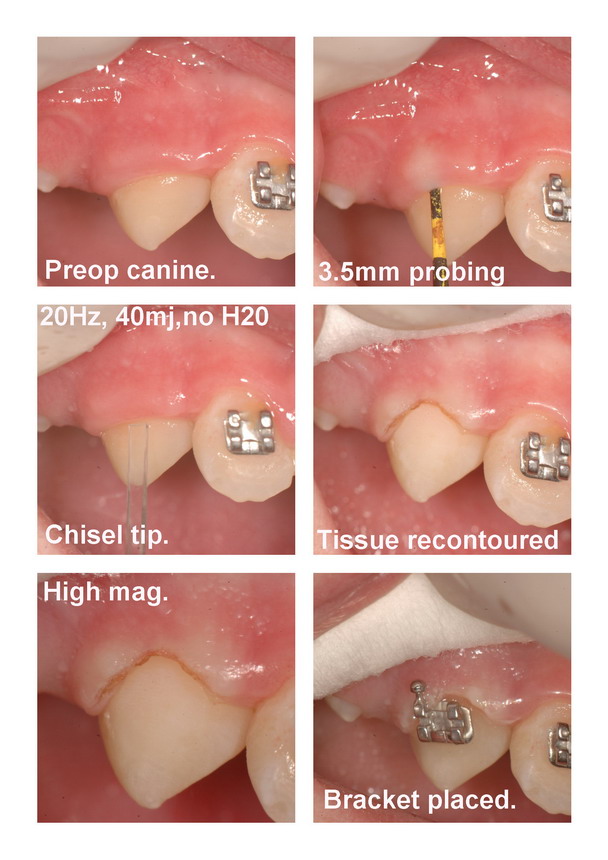 Chisel tip exposure of canine edited and resized.jpg